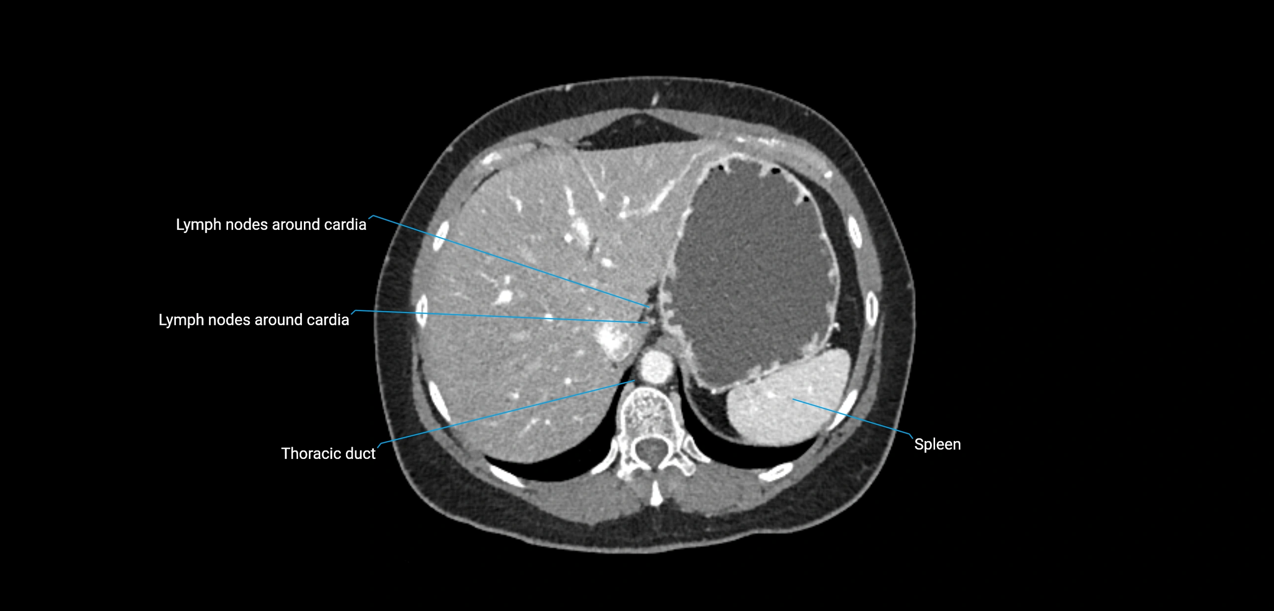 CT ct abdominal lymph nodes  axial cross sectional anatomy  enchanced radiology image -img-00002-00108.webp